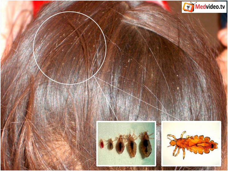 Педикулёз в современной жизни